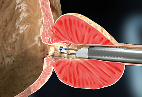 TUR-adenomy-prostaty
