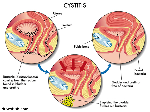 cystitis