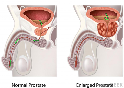diagram-of-enlarged-prostate_11